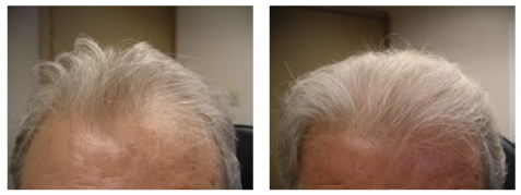 man hair loss before and after photo