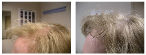 Woman hair loss before and after photo
